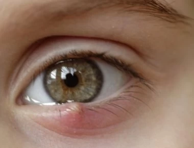 Είναι κριθαράκι ή χαλάζιο; Σε τι διαφέρουν – Αίτια, συμπτώματα, θεραπεία και πρόληψη (βίντεο)